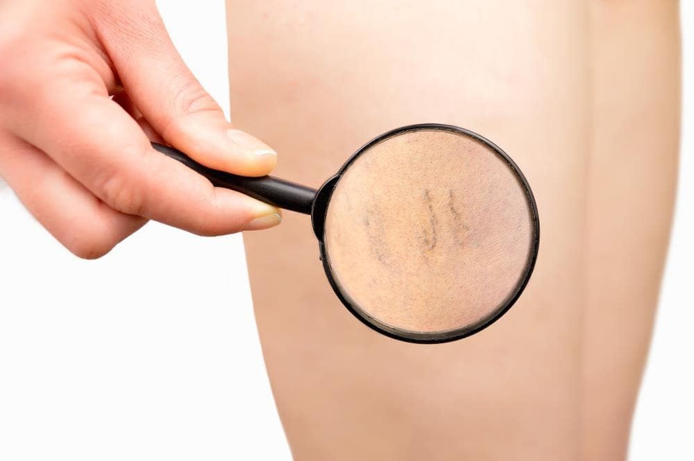 Cómo prevenir y tratar las varices: todo lo que debe saber sobre esta patología vascular y sus opciones terapéuticas