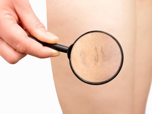 Cómo prevenir y tratar las varices: todo lo que debe saber sobre esta patología vascular y sus opciones terapéuticas